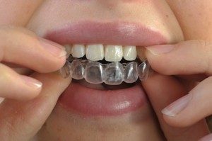 Invisalign Moers Unsichtbare Zahnkorrektur